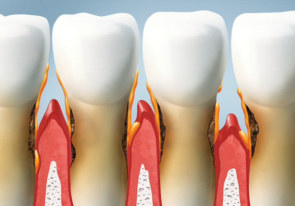 Exploring the stages of gum disease with Dr. Huff
