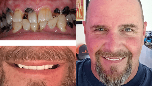 smile reconstruction with full face