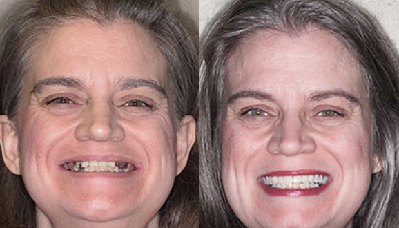 full face reconstruction comparison