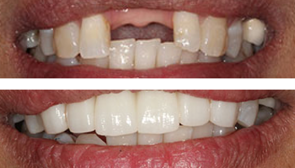 pre and post tooth loss treatment 2