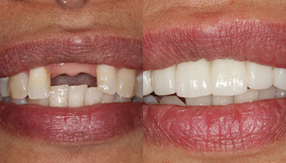 pre and post tooth loss treatment