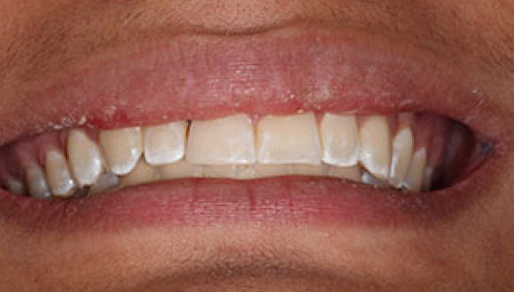 after chipped tooth treatment