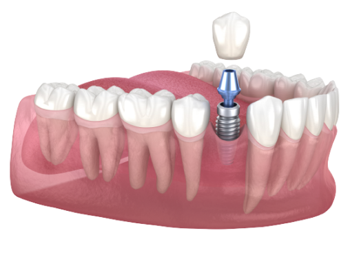 dental implant details