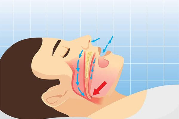 how sleep apnea works in the airway